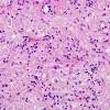 21B2 Ganglioglioma (Case 21) H&E 7