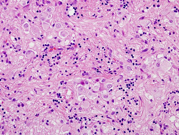 21B2 Ganglioglioma (Case 21) H&E 7