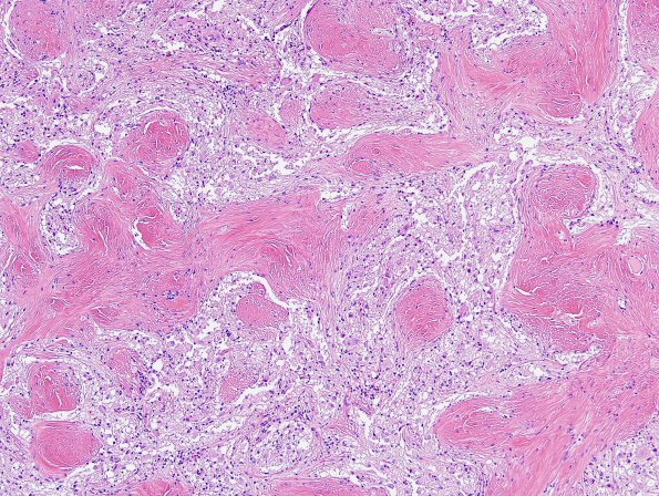 21B3 Ganglioglioma (Case 21) H&E 4