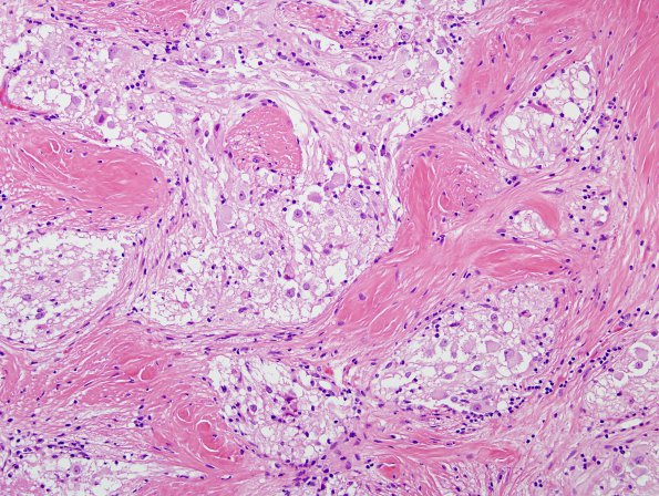 21B4 Ganglioglioma (Case 21) H&E 2