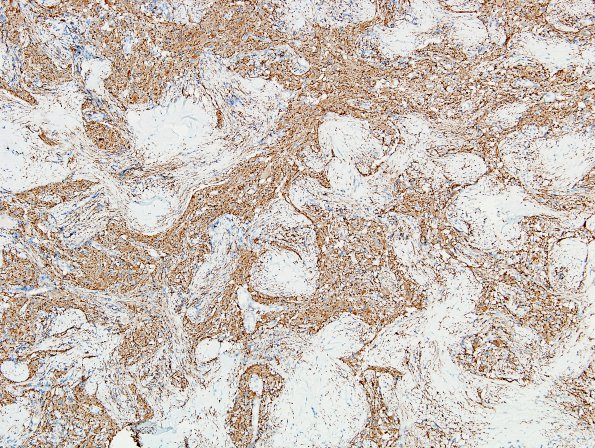 21C1 Ganglioglioma (Case 21) SYN 9