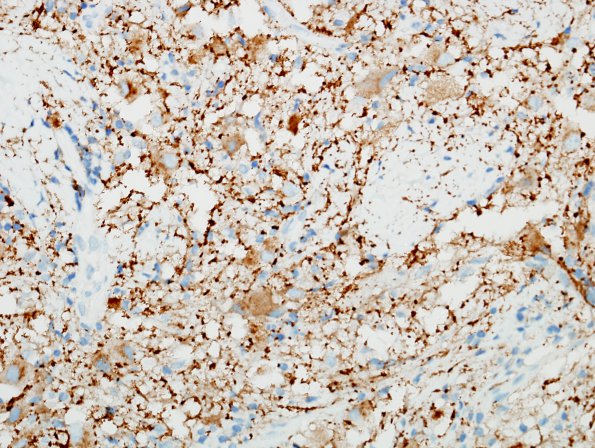 21C2 Ganglioglioma (Case 21) SYN 6