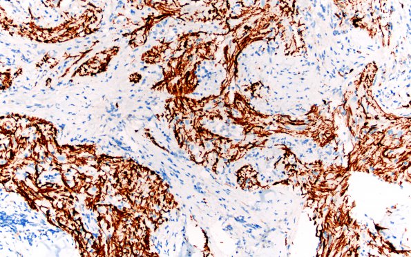 21D2 Ganglioglioma (Case 21) GFAP 20X