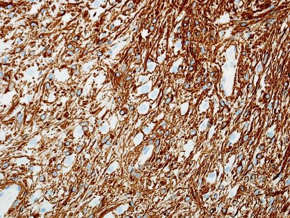 21D3 Ganglioglioma (Case 21) GFAP 3