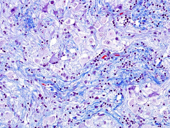 21E Ganglioglioma (Case 21) Trichrome 4