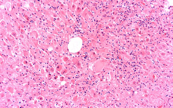 22A1 Ganglioglioma (Case 22) H&E 20X