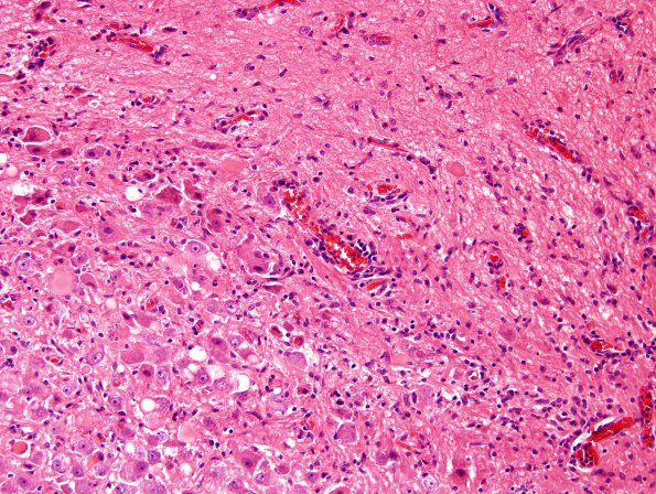 22A2 Ganglioglioma (Case 22) H&E 5