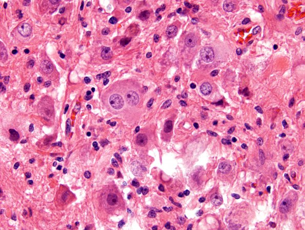 22A3 Ganglioglioma (Case 22) H&E 2