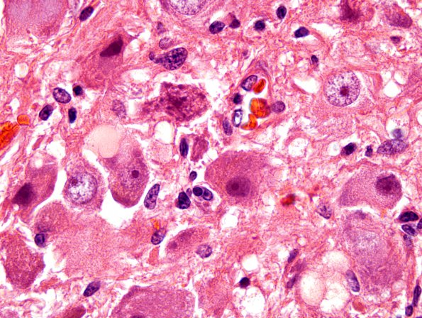 22A4 Ganglioglioma (Case 22) H&E 3