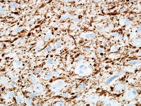 22C1 Ganglioglioma (Case 22) NF3