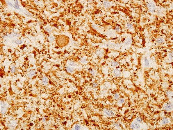 22C2 Ganglioglioma (Case 22) NF5