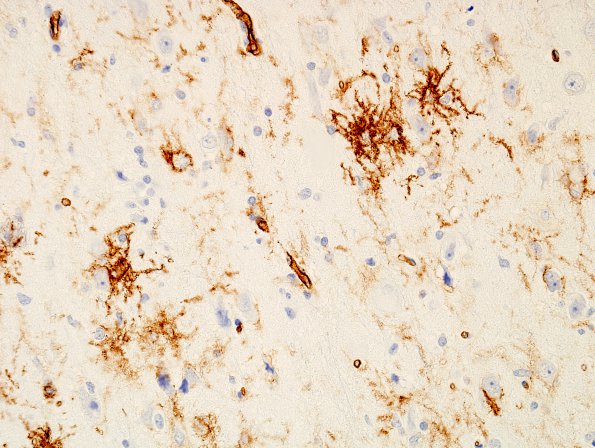 22D2 Ganglioglioma (Case 22) CD34 1