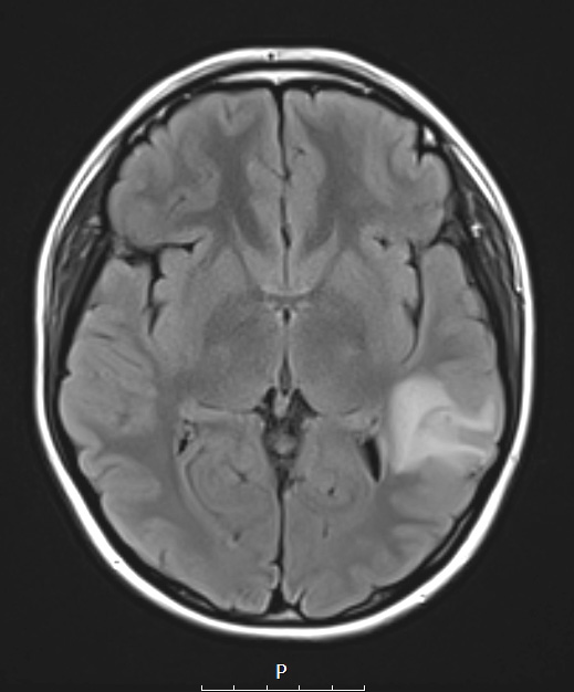 23A1 Ganglioglioma (Case 23) T2 FLAIR 2