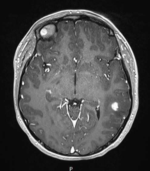 23A3 Ganglioglioma (Case 23) T1W