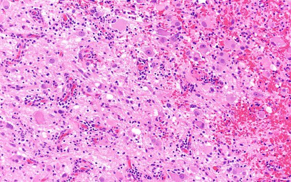 23B1 Ganglioglioma (Case 23) B2 H&E 20X 2