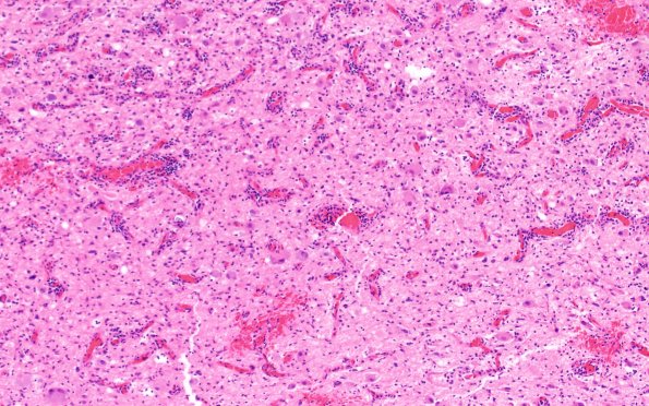 23B3 Ganglioglioma (Case 23) B2 H&E 10X