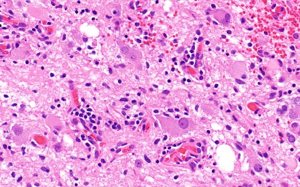 23B4 Ganglioglioma (Case 23) B2 H&E 40X 3