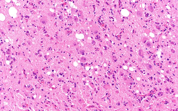 23B5 Ganglioglioma (Case 23) D1 H&E 20X 1