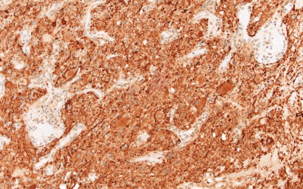 23C3 Ganglioglioma (Case 23) B2 SYN area A 20X