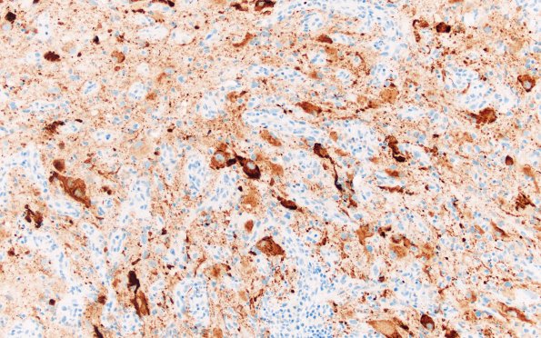 23D1 Ganglioglioma (Case 23) D1 CHR 20X