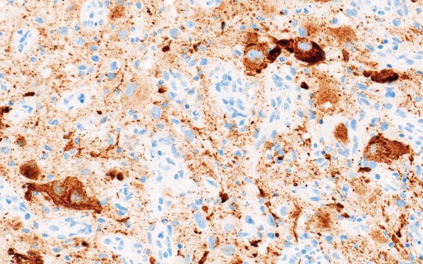 23D2 Ganglioglioma (Case 23) D1 CHR 40X 2