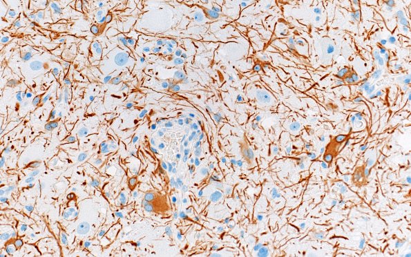 23E2 Ganglioglioma (Case 23) NF 40X 1