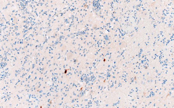 23F1 Ganglioglioma (Case 23) B2 NeuN area A 20X 3