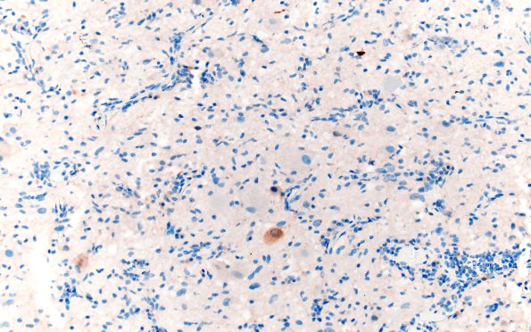 23F3 Ganglioglioma (Case 23) NeuN 20X 2