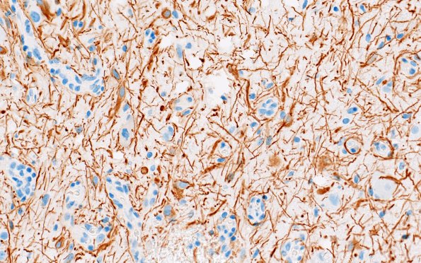 23G2 Ganglioglioma (Case 23) D1 GFAP 40X 9