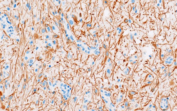 23G3 Ganglioglioma (Case 23) D1 GFAP 40X 10