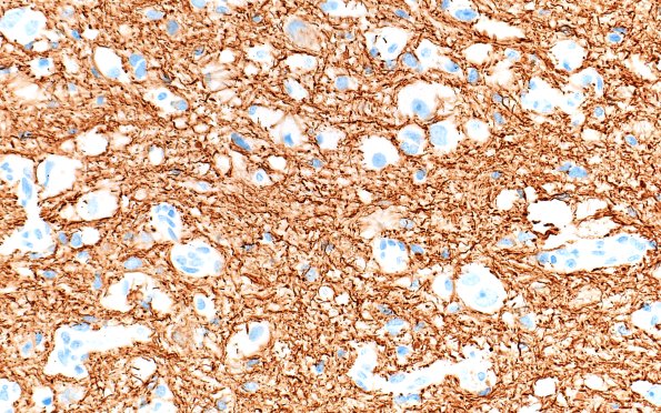 23G5 Ganglioglioma (Case 23) GFAP 40X 1