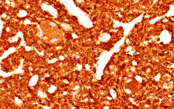 23H1 Ganglioglioma (Case 23) D1 BRAFv600e 40X 1