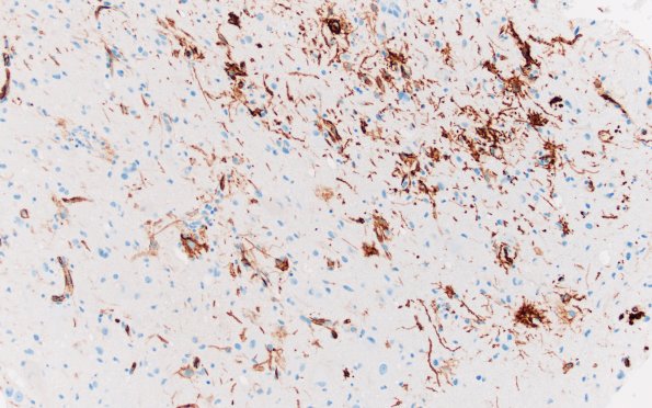 23I2 Ganglioglioma (Case 23) D1 CD34 20X 1