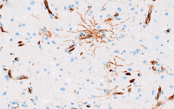 23I4 Ganglioglioma (Case 23) D1 CD34 40X 2