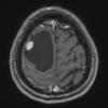 2A1 Ganglioglioma (Case 2) T1 1 - Copy