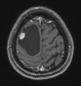 2A1 Ganglioglioma (Case 2) T1 1 - Copy