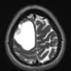 2A2 Ganglioglioma (Case 2) T2 noC 1 - Copy