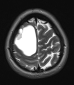 2A2 Ganglioglioma (Case 2) T2 noC 1 - Copy