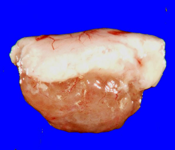 2B1 Ganglioglioma (Case 2) gross_3