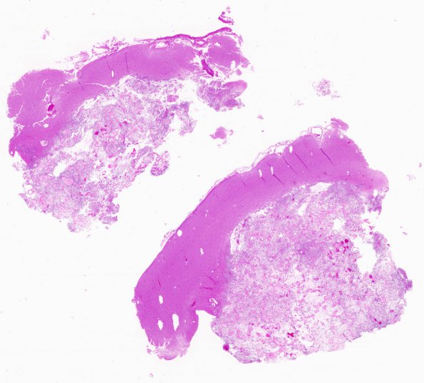 2C1 Ganglioglioma (Case 2) H&E whole mount