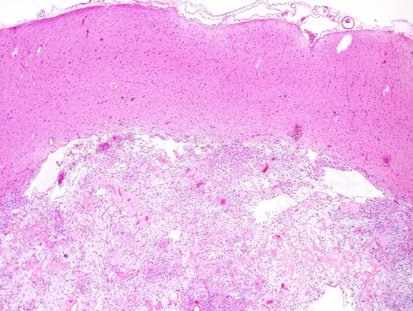 2C2 Ganglioglioma (Case 2) H&E 7