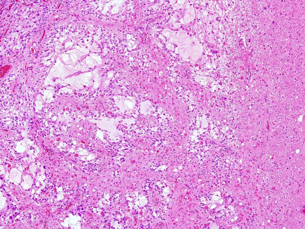 2C3 Ganglioglioma (Case 2) H&E 2