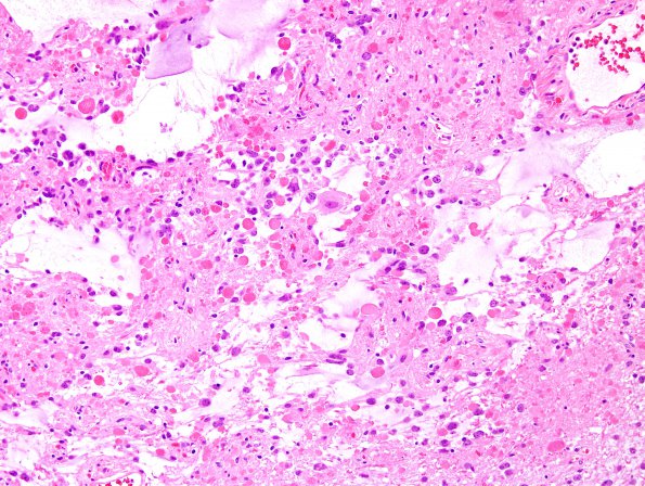 2C4 Ganglioglioma (Case 2) H&E 5