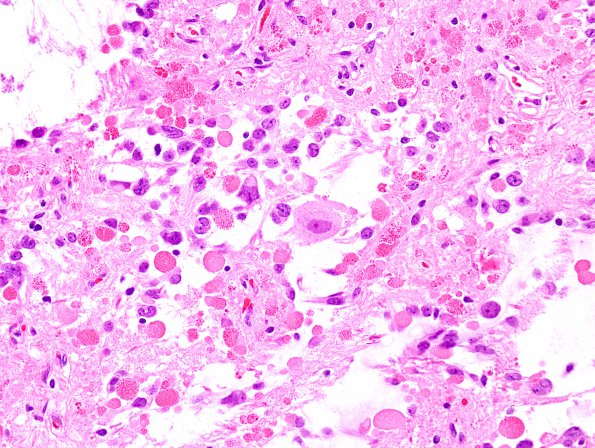 2C5 Ganglioglioma (Case 2) H&E 4