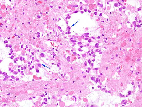 2C6 Ganglioglioma (Case 2) H&E 1 copy