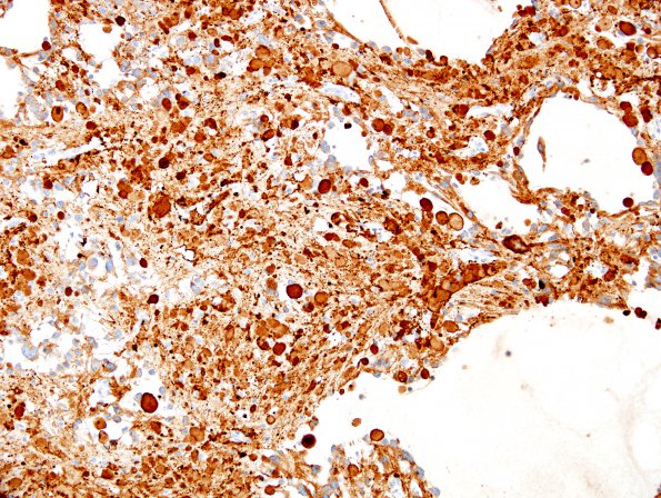 2D1 Ganglioglioma (Case 2) SYN 1