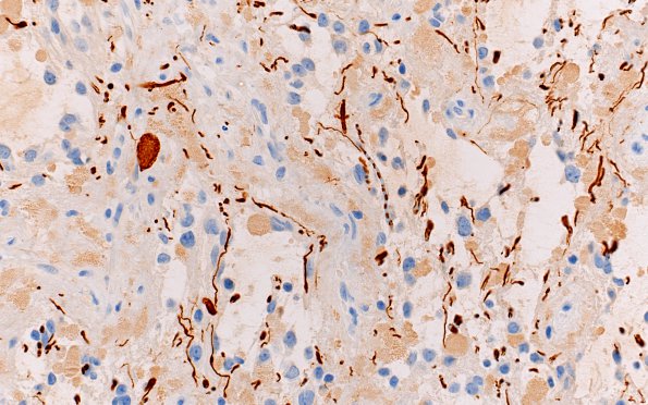 2E2 Ganglioglioma (Case 2) NF 40X