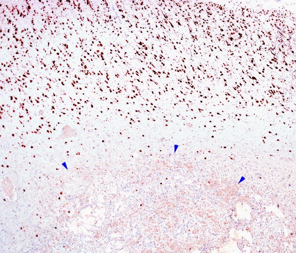 2F1 Ganglioglioma (Case 2) NeuN 1 copy