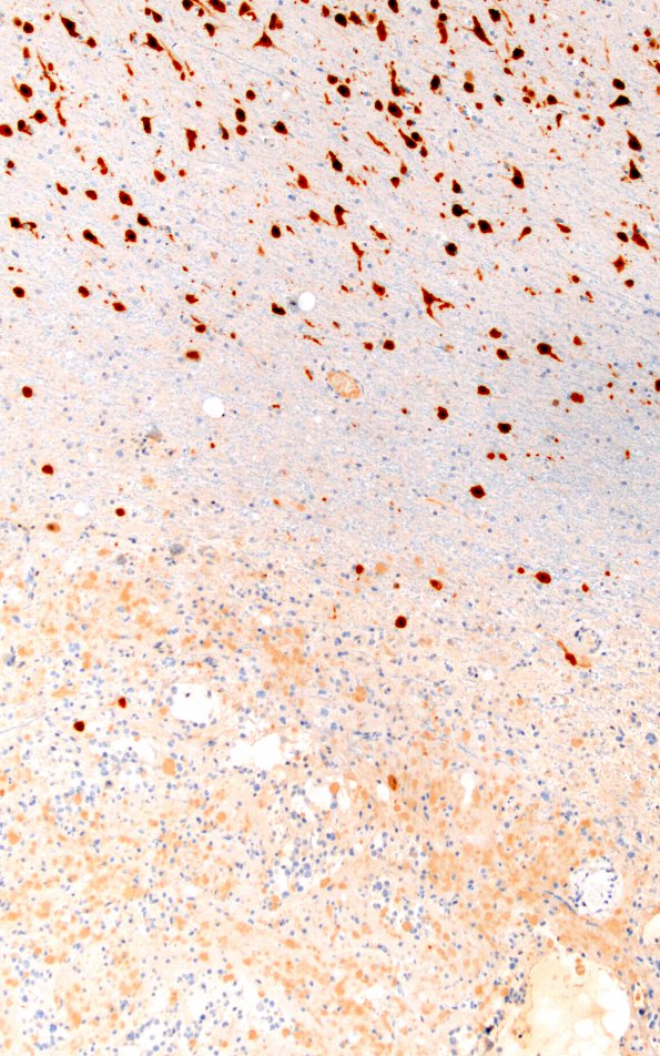 2F2 Ganglioglioma (Case 2) NeuN 10X