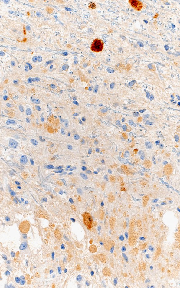 2F3 Ganglioglioma (Case 2) NeuN 40X